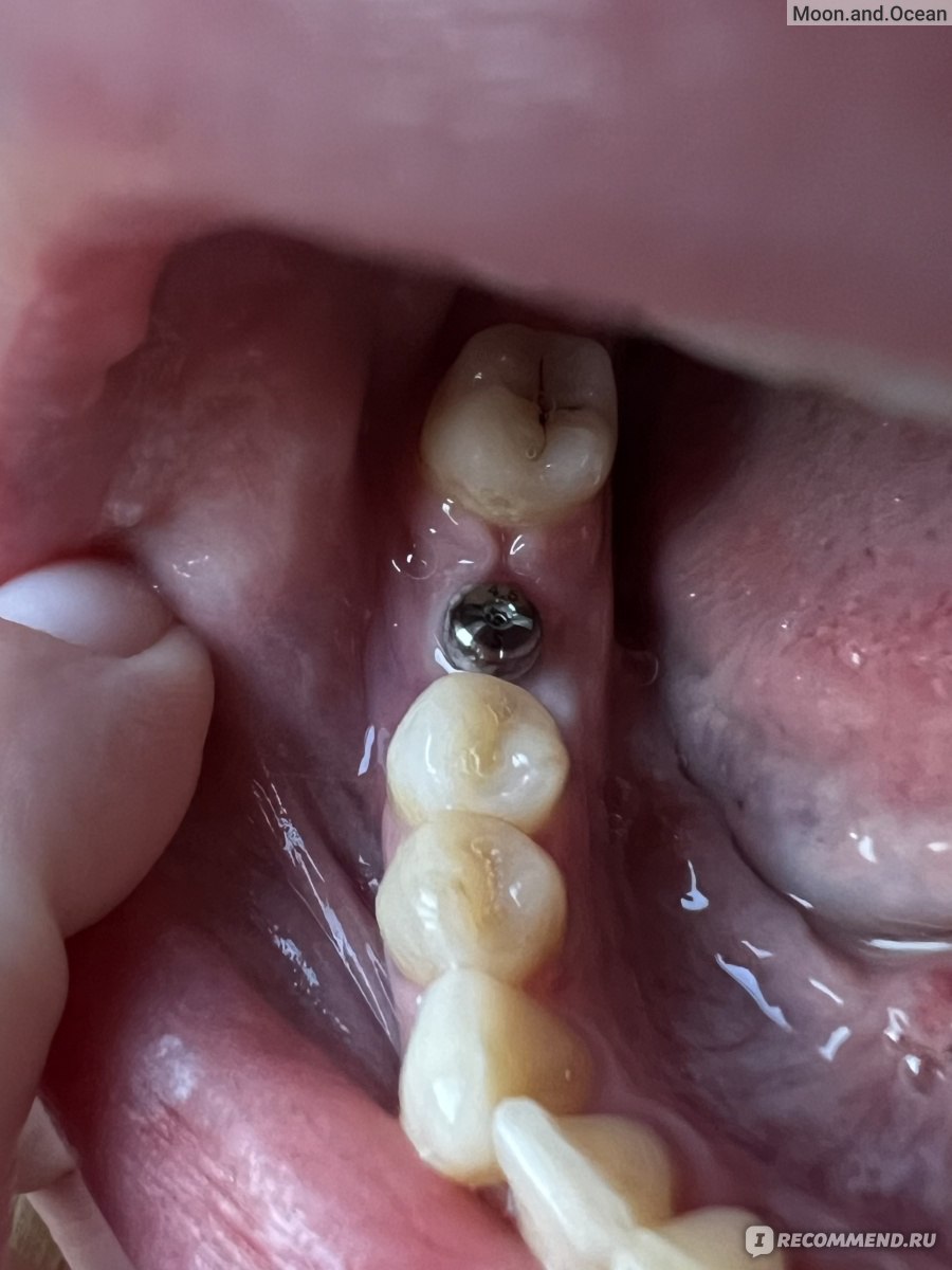 Мышьяк в зубе: что делать, если болит по-прежнему?