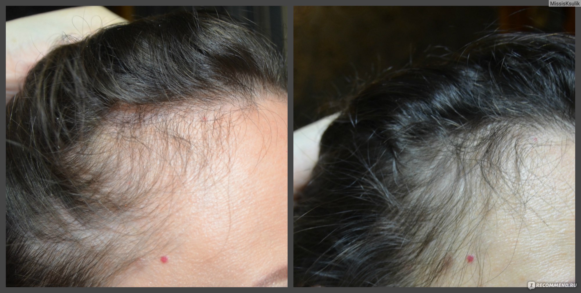 Последствия выпадения волос