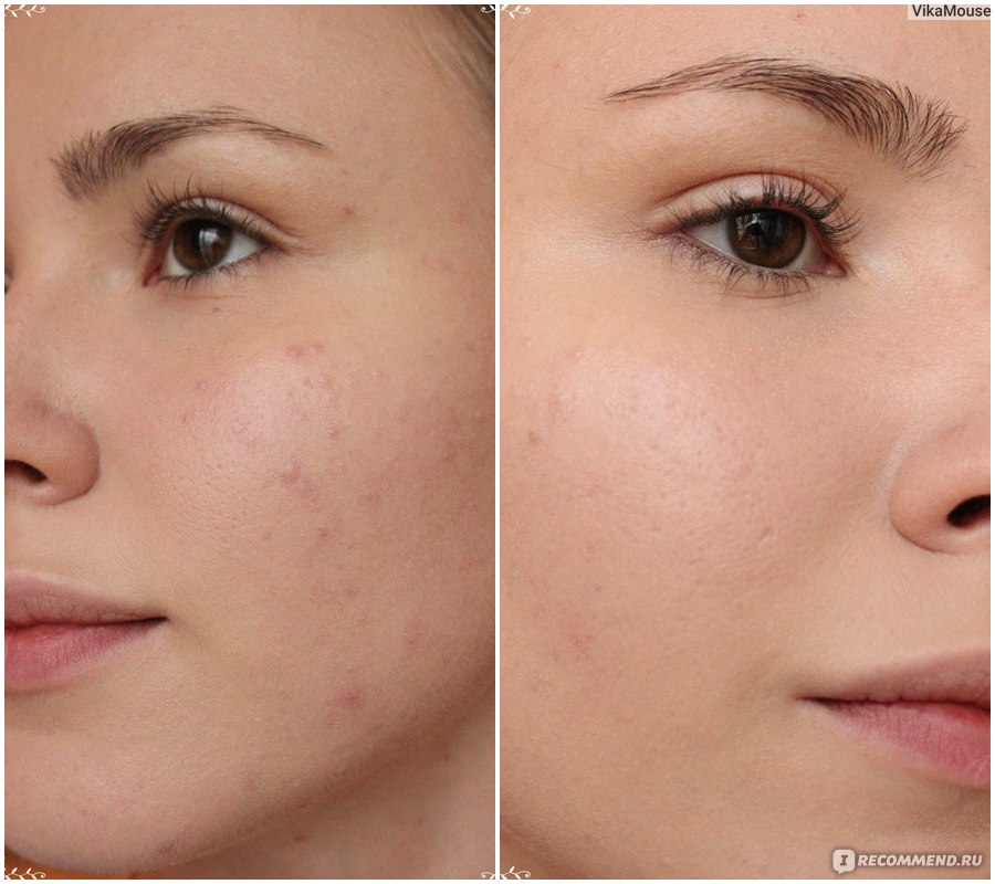 тональный крем ложится. скатывание тонального крема. тональный крем скатался на лице. тональный крем для лица. скатывание тонального крема.