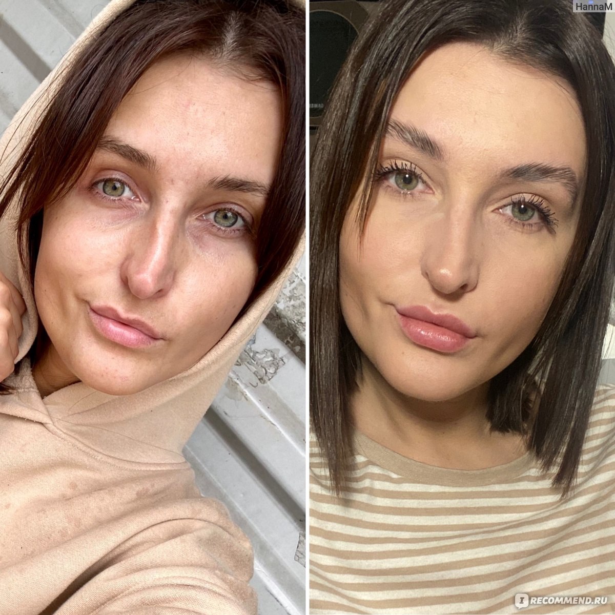 Белотеро филлер для лица до и после фото