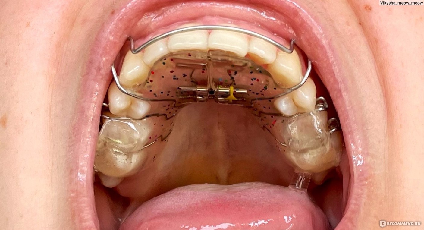 Почему зубы у взрослых становятся кривыми