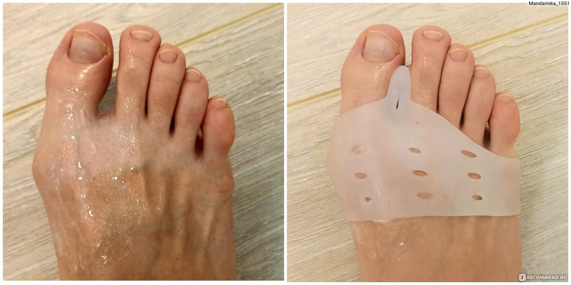 Шишка на ноге: причины, диагностика и методы лечения косточек на пальцах
