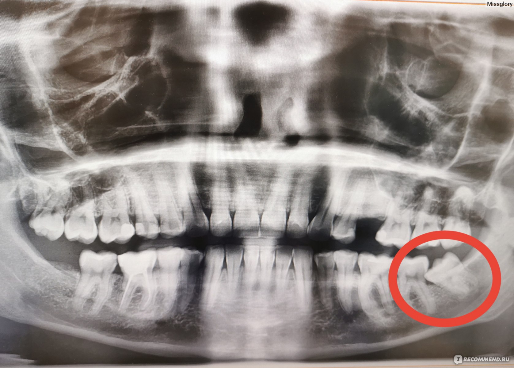 Осложнения после удаления зубов. Какие бывают и почему возникают?