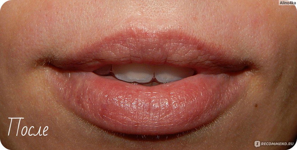 почему у женщин растут усики над губой | Дзен