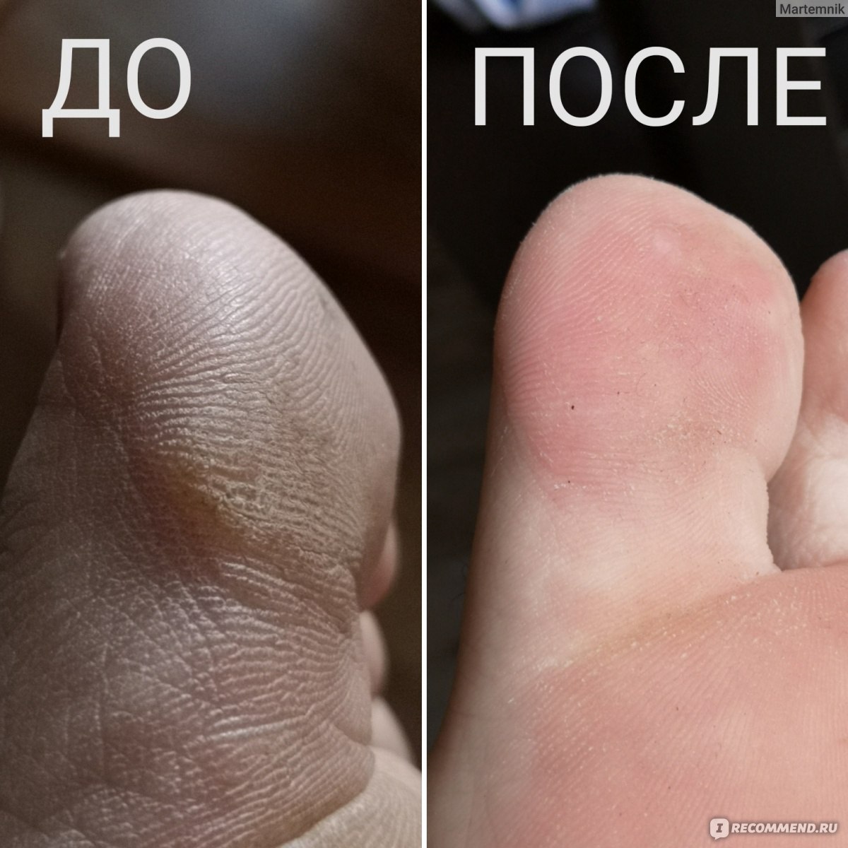 Фото пяток до и после педикюра