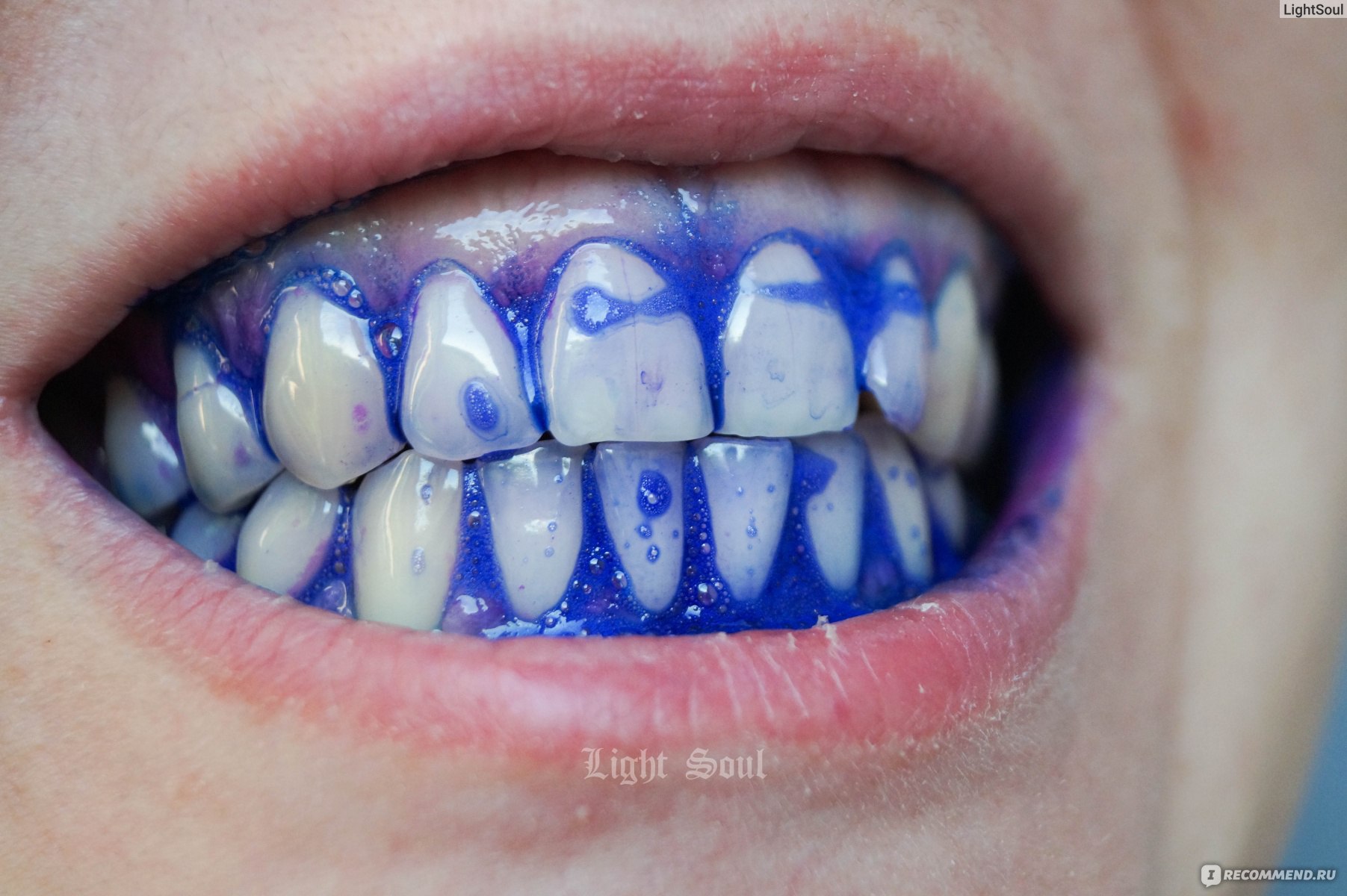 Черный налет на зубах: как удалить