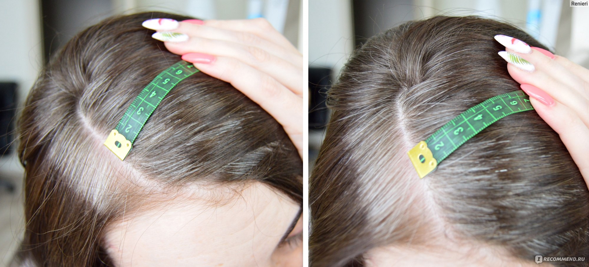Как пользоваться мезороллером в домашних условиях для волос
