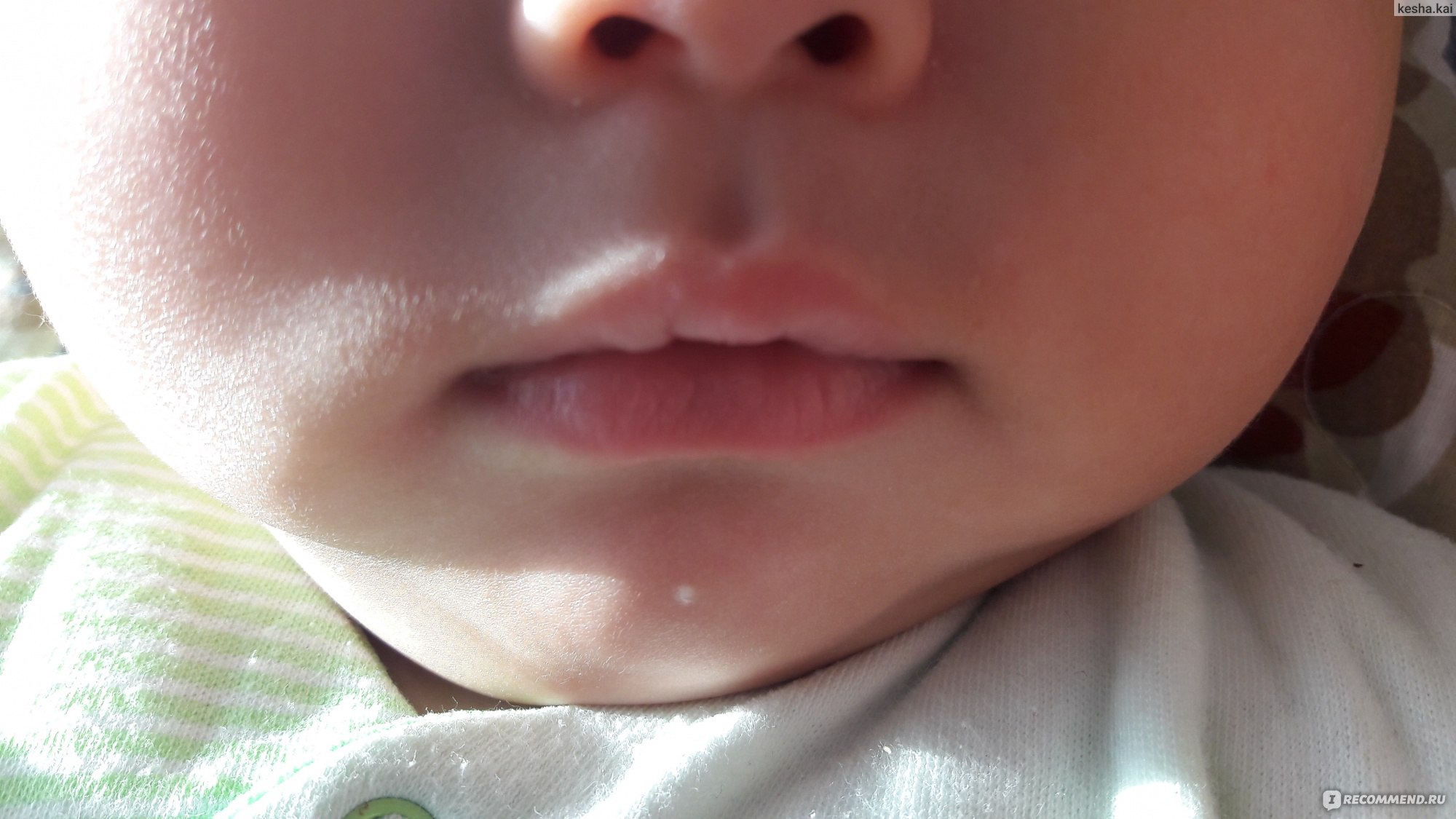 Мозоль на верхней губе у ребенка