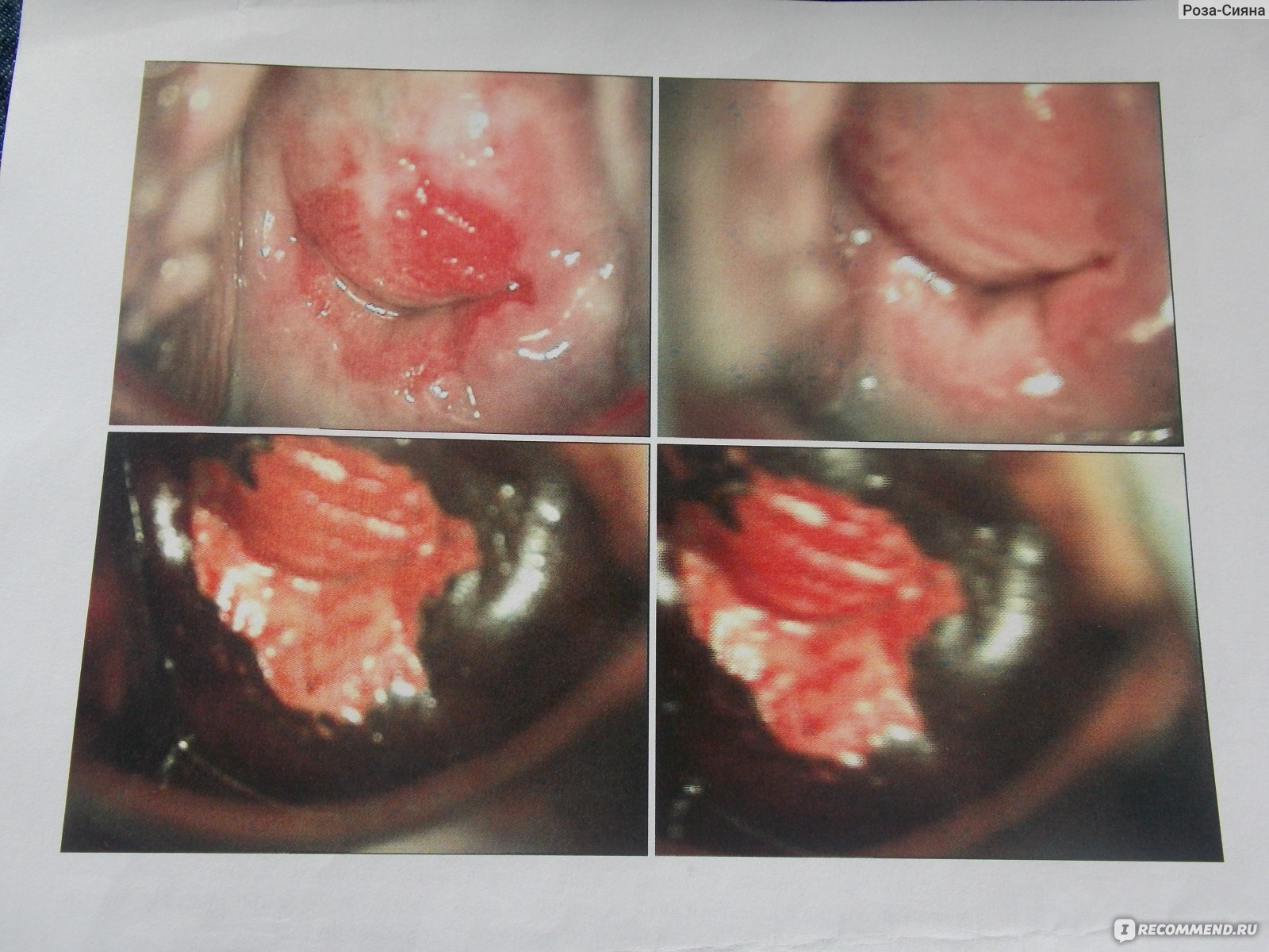 эрозия шейки матки от члена фото 90