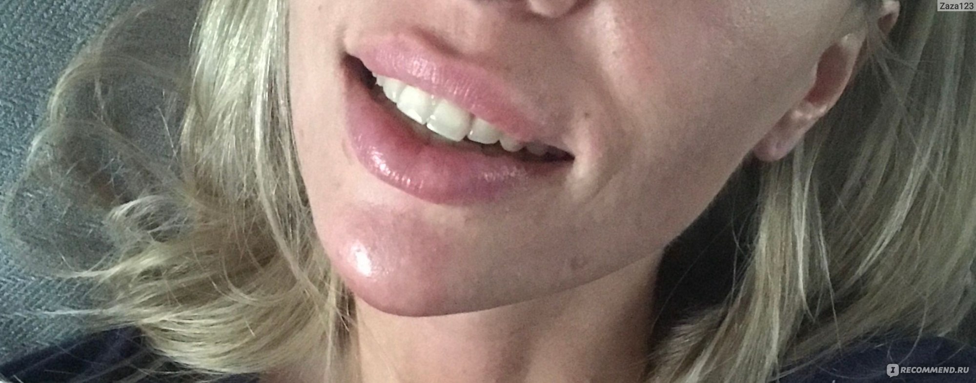 Фиброз на губах от гиалуроновой
