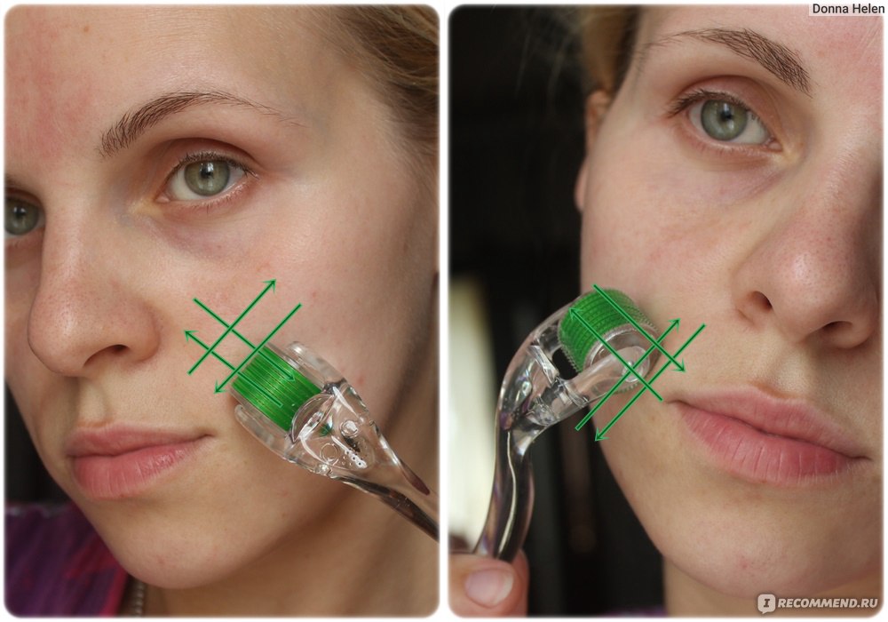 Мезороллер фото до и после применения для лица
