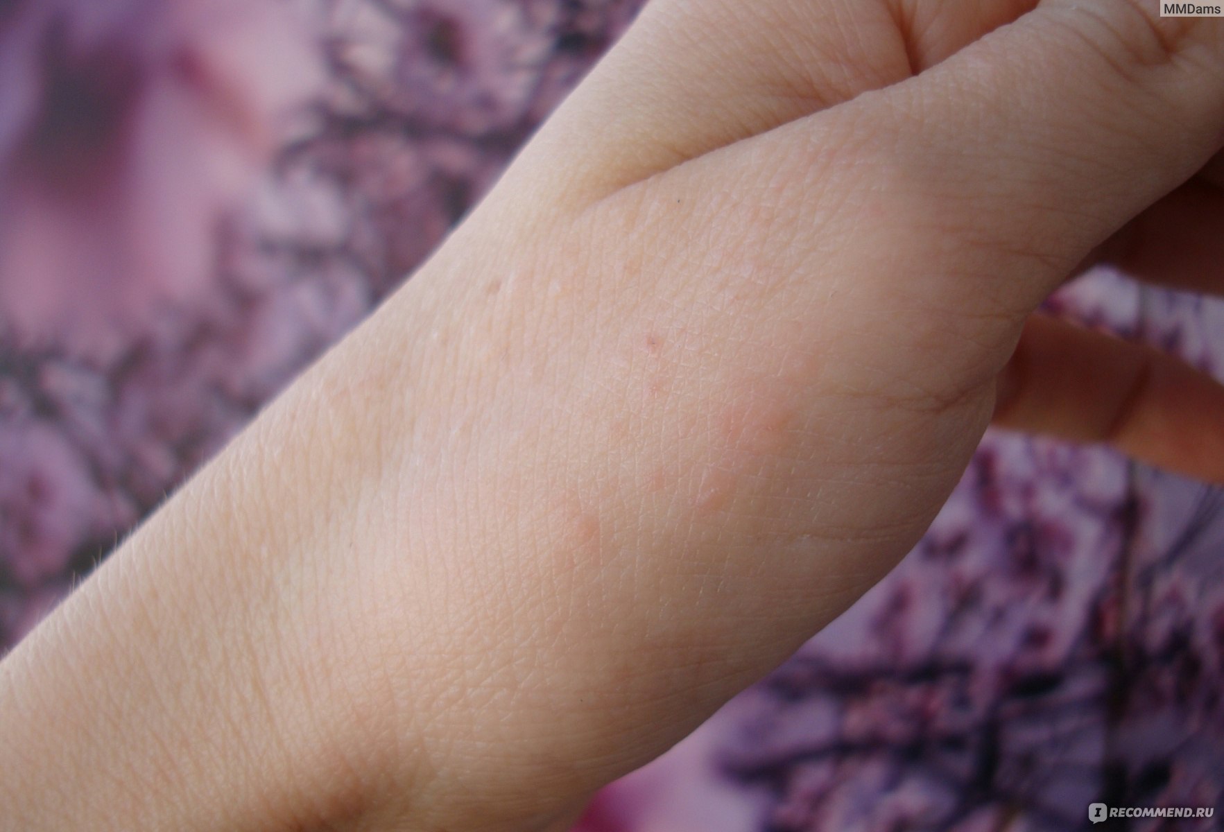 Аллергия на холод на коже рук