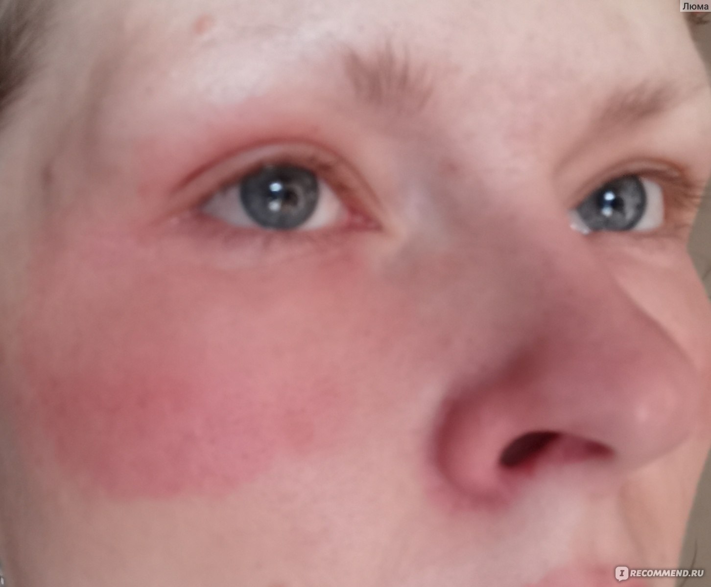 Причины аллергии у взрослых и детей