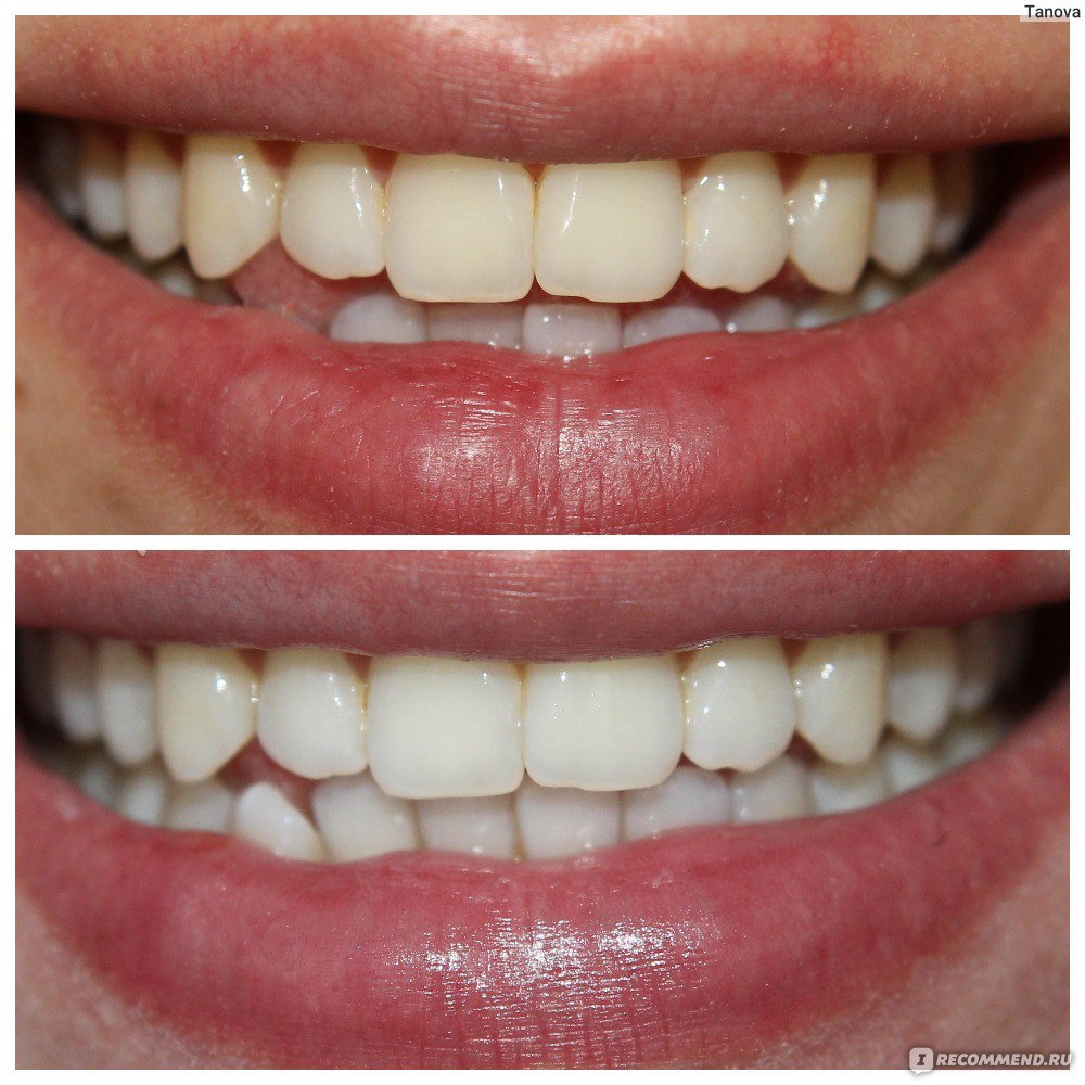 Зубы до и после отбеливания полосками чистить зубы ирригатором