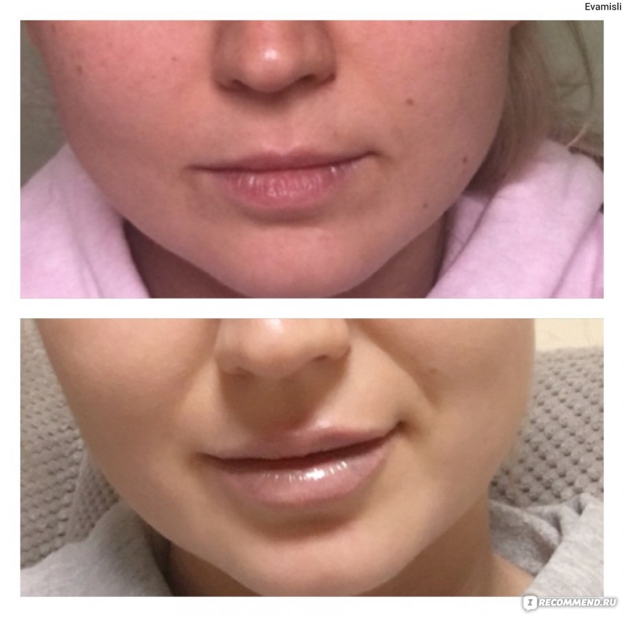 Увеличение губ Juvederm - «Игра стоит свеч» | отзывы