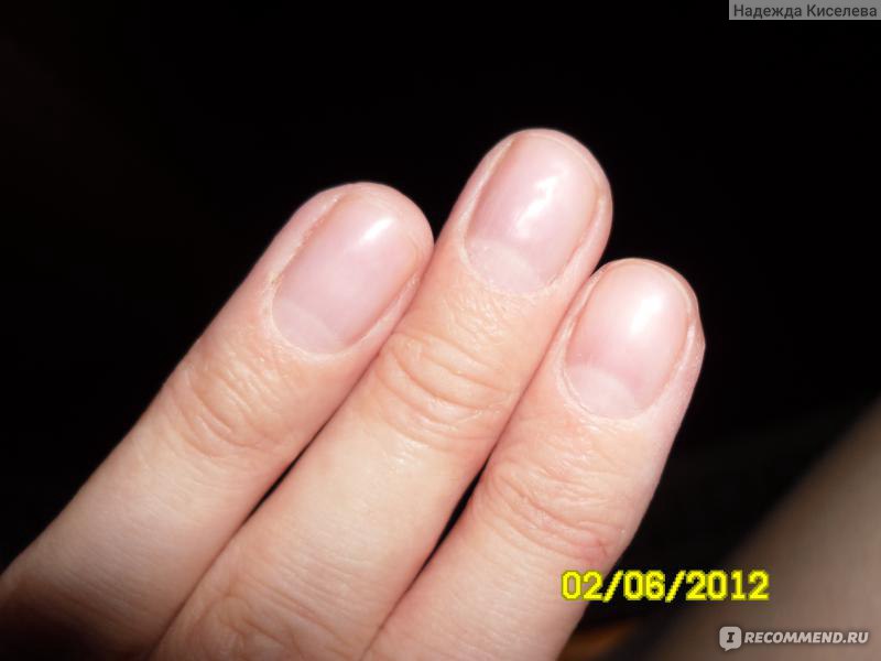 Почему ногти становятся ребристыми: причины и лечение | VK