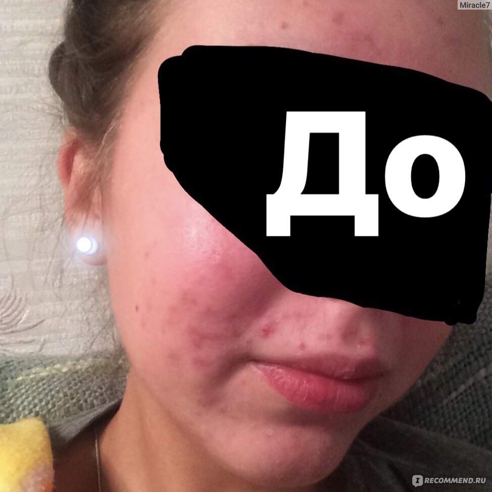 Таблетки от акне Almirall Aknenormin. 