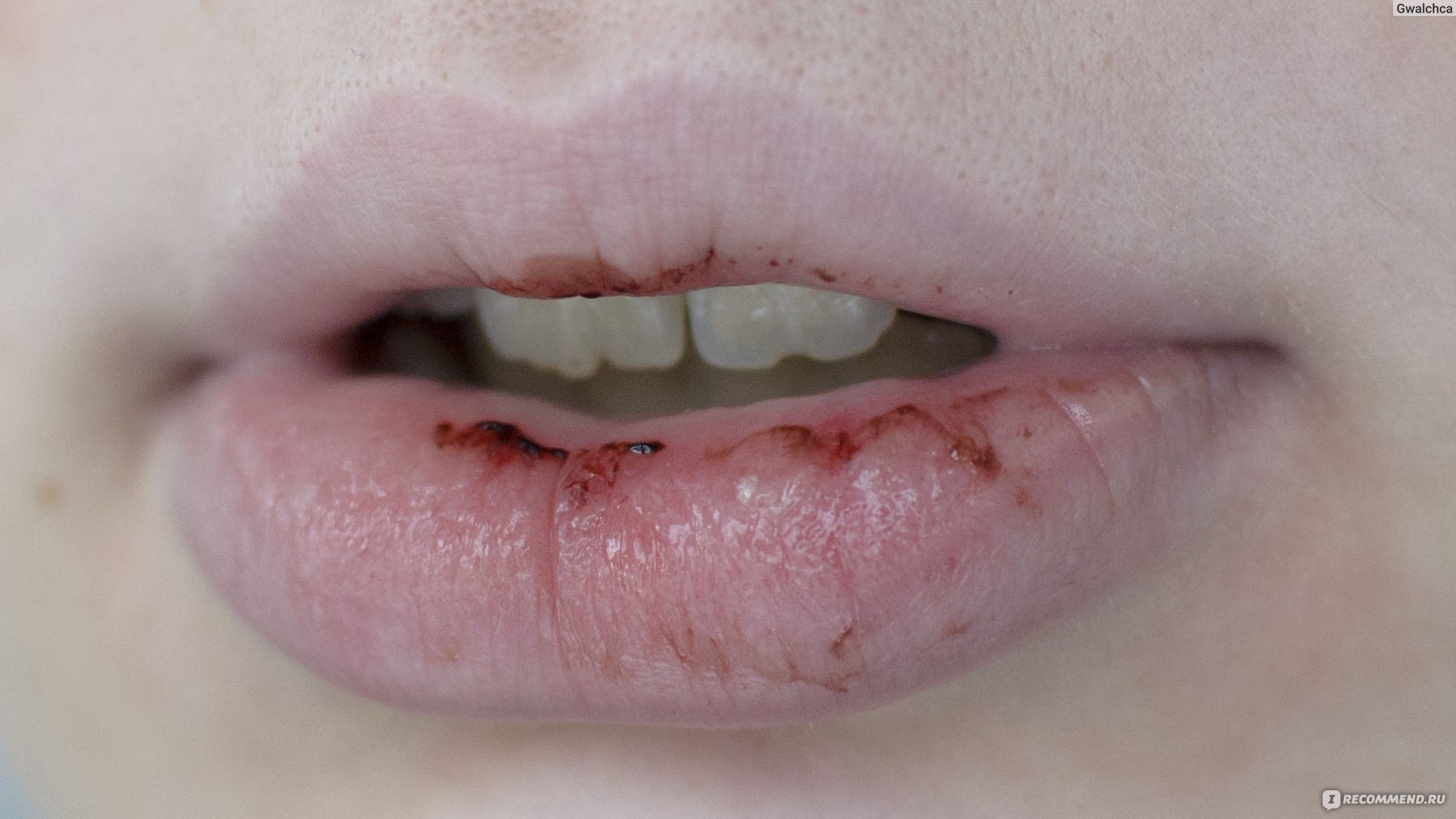 Хроническая трещина губы.Что делать?