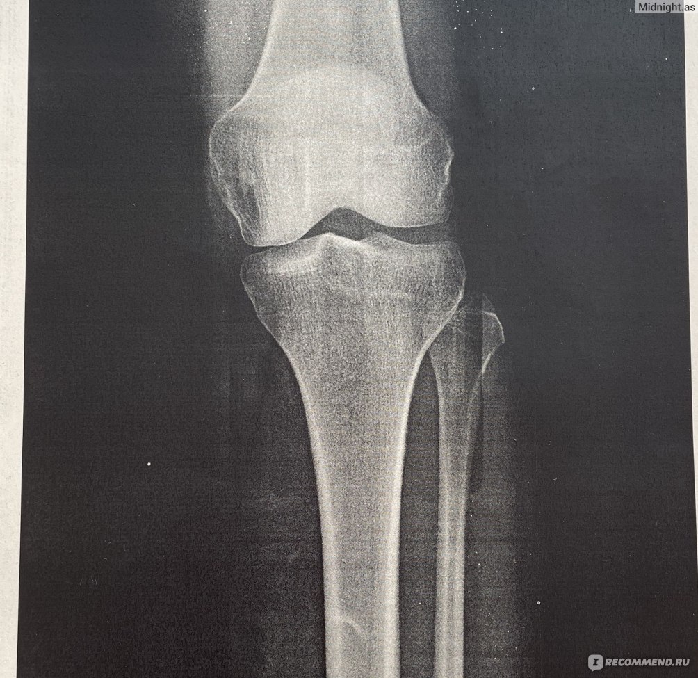 Рентген коленного сустава: эффективность процедуры