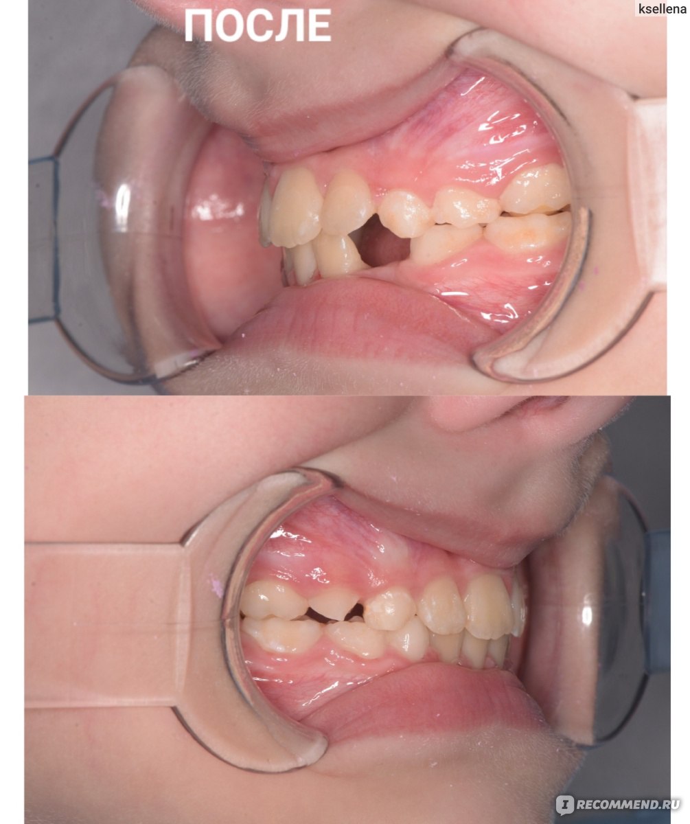 Брекет-системы / брекеты / ортодонтические скобы - «Брекеты детям: как  ставят брекеты в 8 лет, сколько длится лечение. Фото ДО/ПОСЛЕ, дневник  наблюдений, ЦЕНА на брекеты в 2023 году. Очень ПОДРОБНЫЙ отзыв со