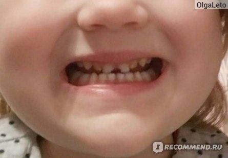 Реставрация молочных зубов Томск Вилюйская