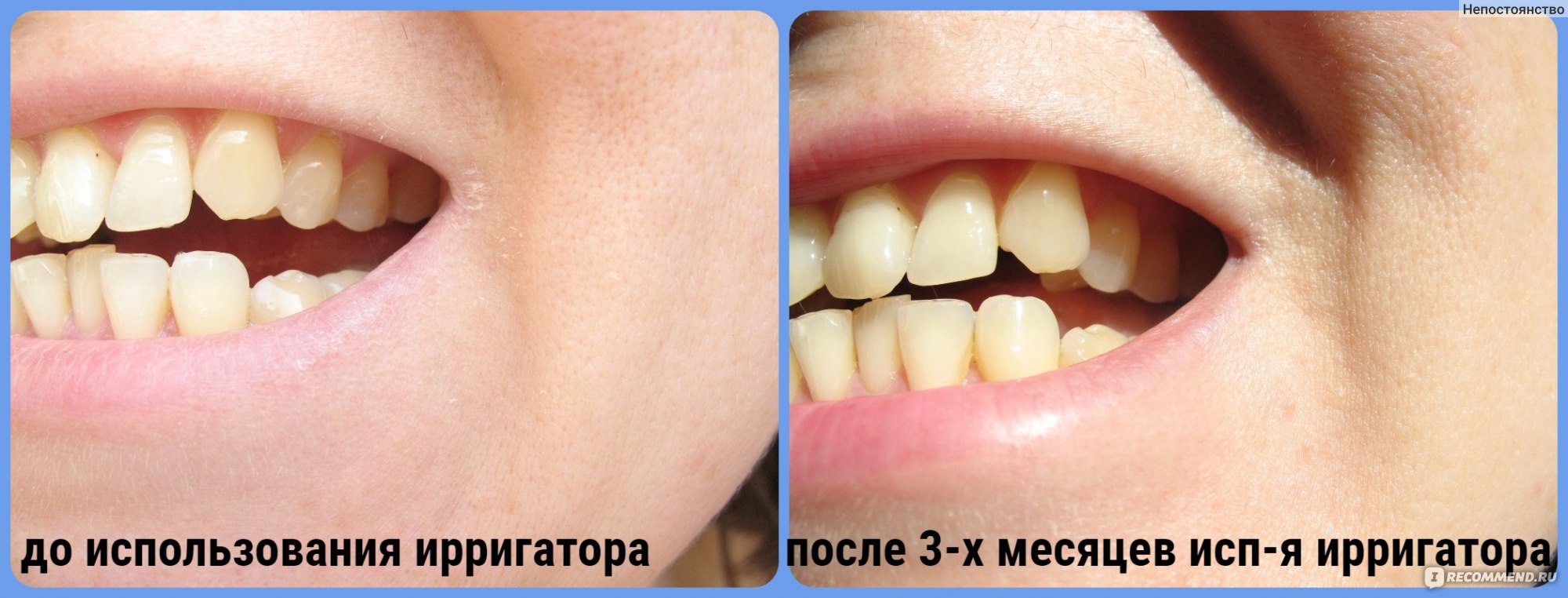 Зубы до и после ирригатора