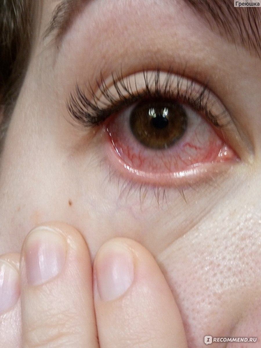 Красный глаз после ресниц. Альергия нв наращенные ресницы. Красные глаза от наращивания. Аллергия на наращивание ресниц. Аллергическая реакция на тушь.