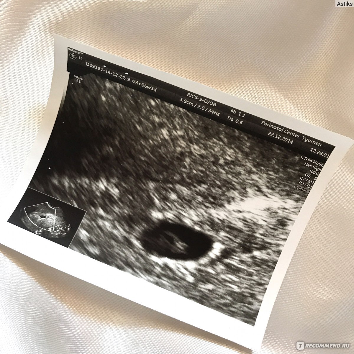 Снимок УЗИ на 6 неделе беременности