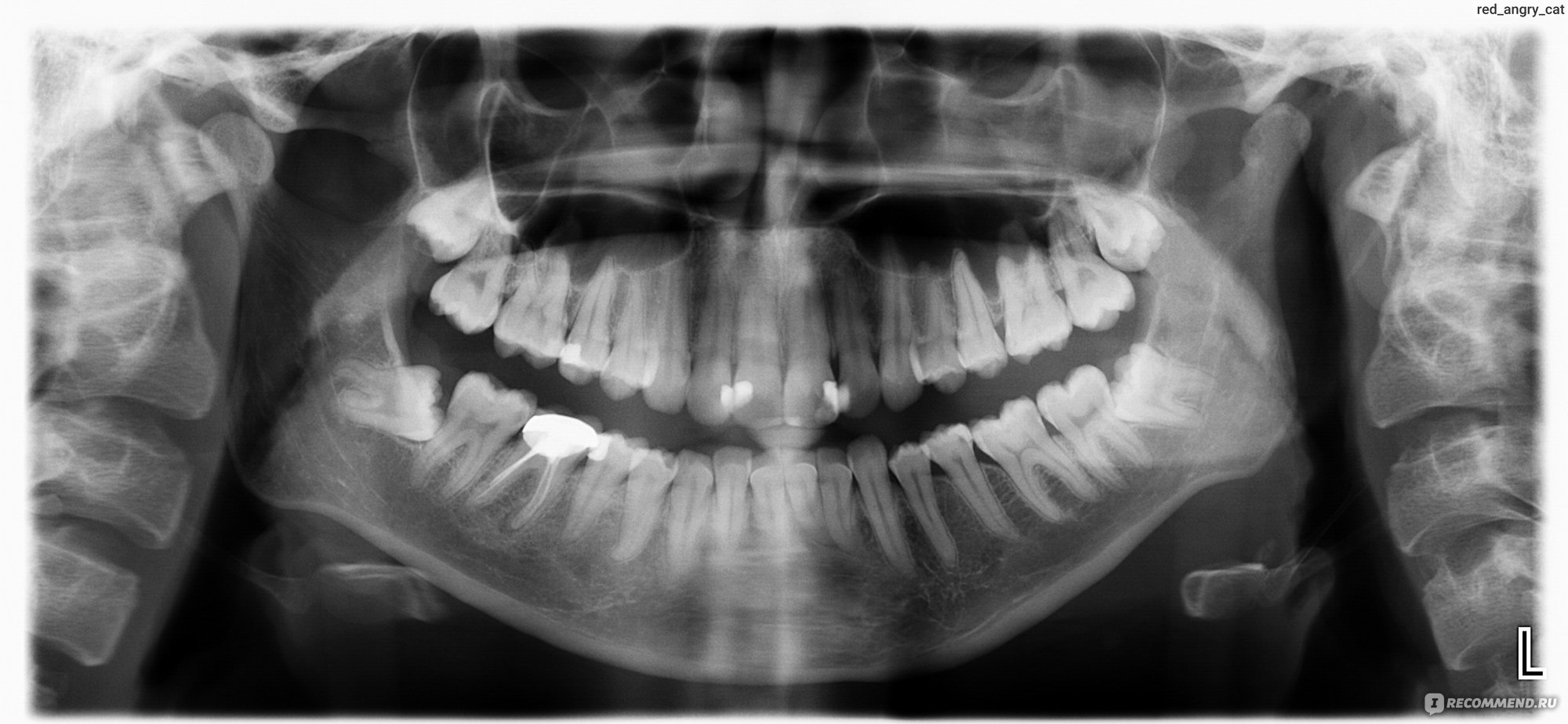 Альвеолит лунки зуба рентген