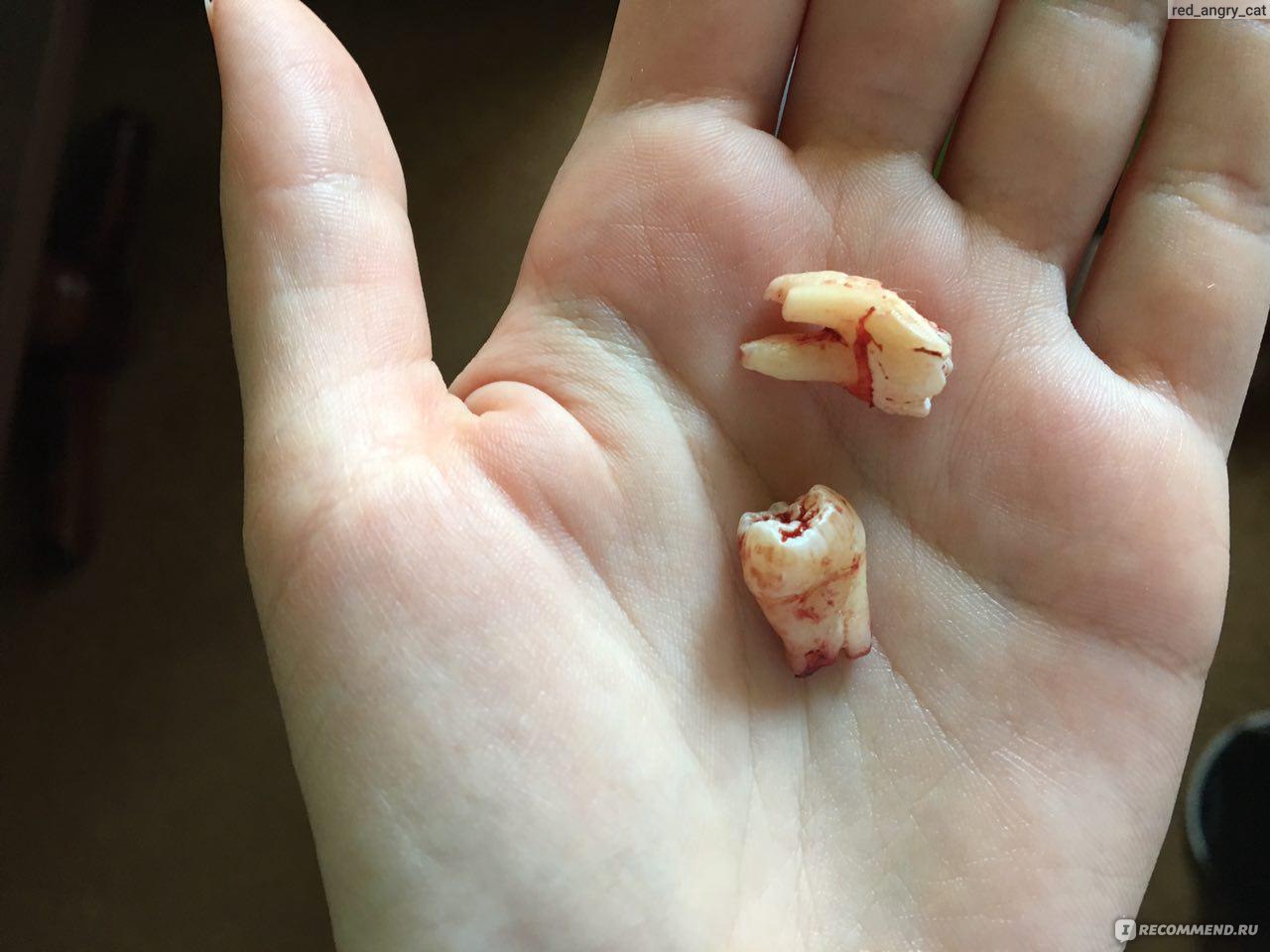 Сколько заживает десна после удаления зуба?