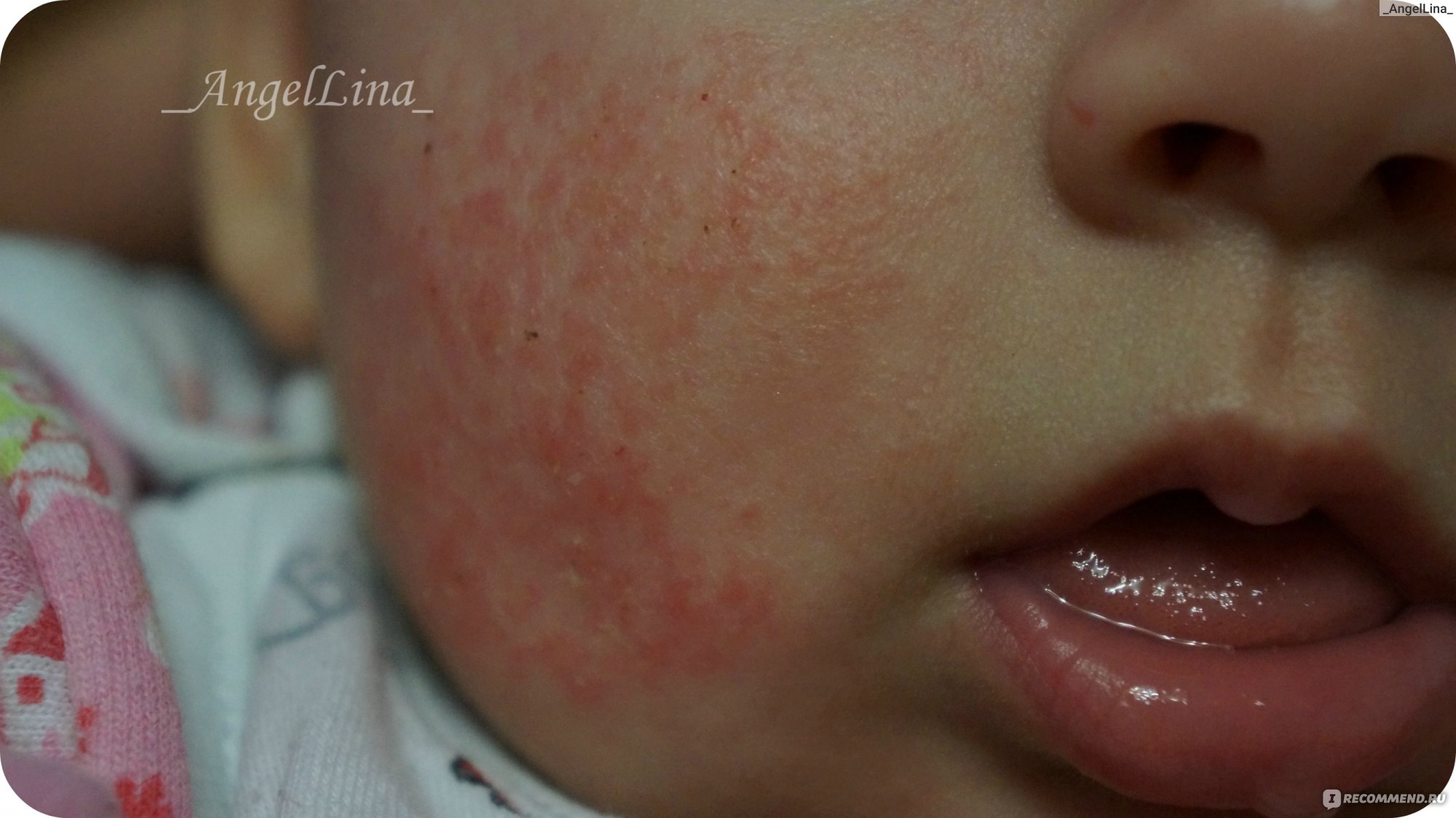 Пищевая аллергия у новорожденных, симптомы и лечение — блог Nutricia