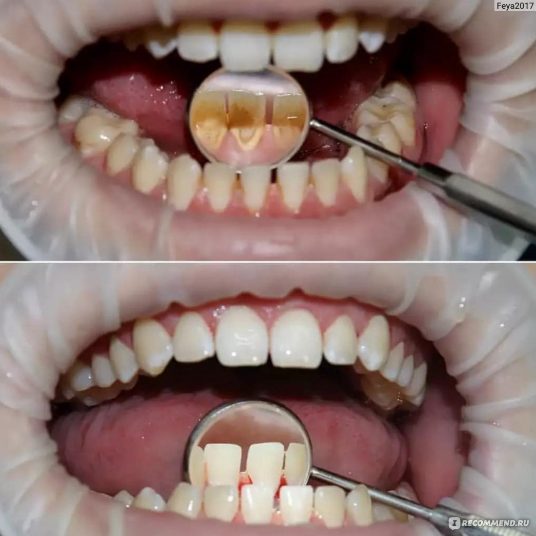 Полировка зубов и чистка до и после фото