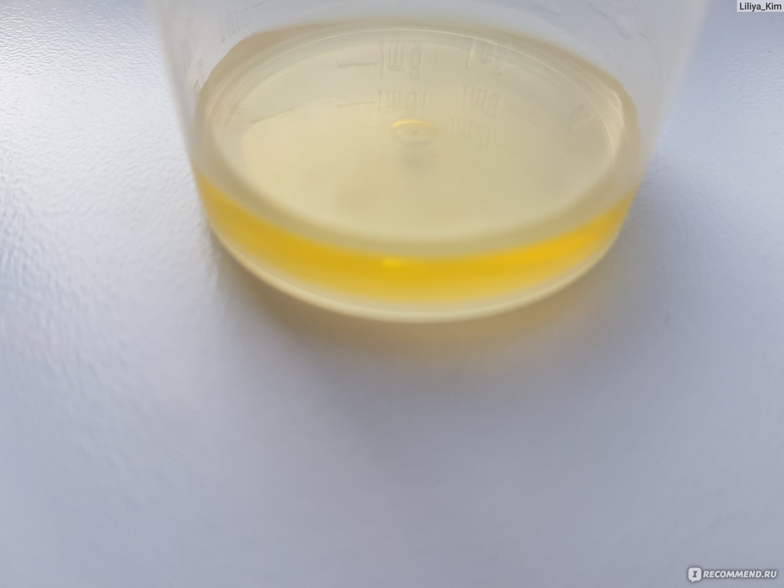 Weiße fetzen im urin