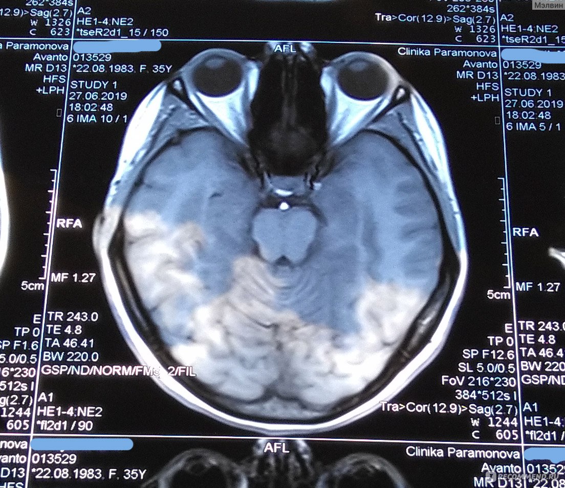 Магнитно-резонансная томография (МРТ) головного мозга - «МРТ головного  мозга в Клинике доктора Парамонова (Саратов) - впечатлений больше, чем от  сеанса в 7D кинотеатре. Уже 3 раза ходила!» | отзывы