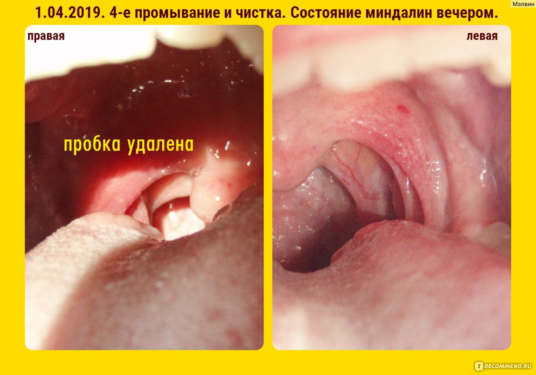 Цена лечения пробок в горле в Москве
