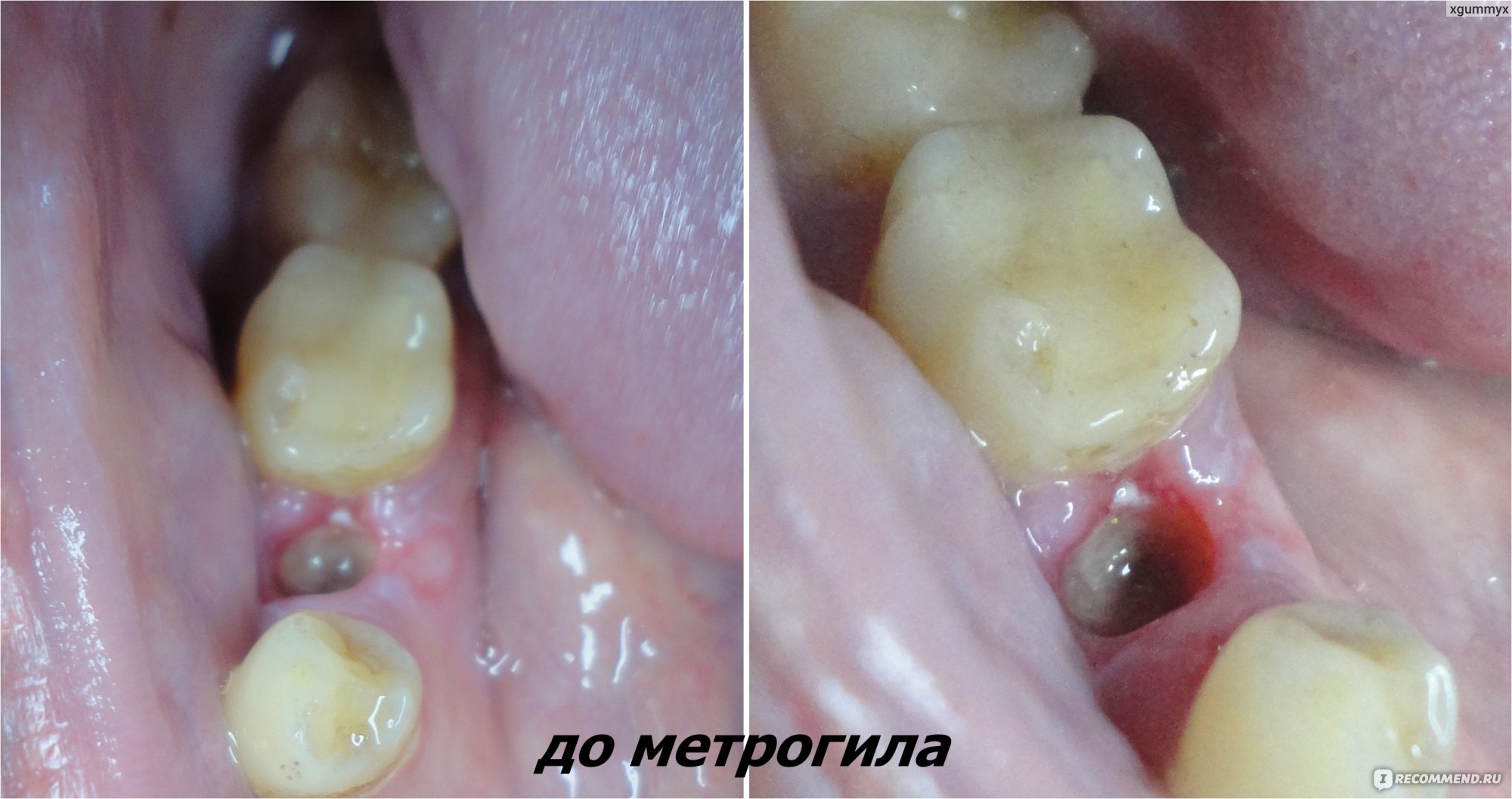 Альвеолит лунки зуба: симптомы и виды | Профилактика и лечение альвеолита в «СМ-Стоматология»
