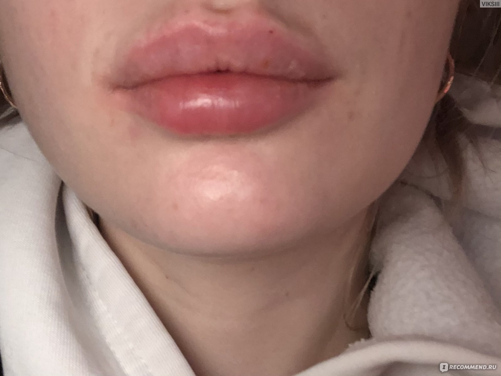 форма губ после гиалуроновой кислоты фото