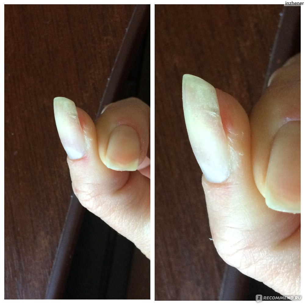 Как восстановить палец после