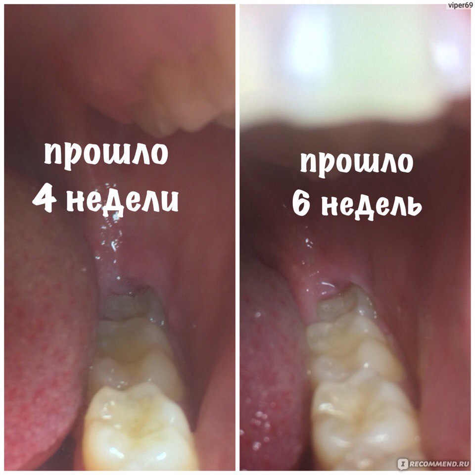Иссечение капюшона зуба мудрости Томск Доверия Удаление зубного камня Томск Наумова