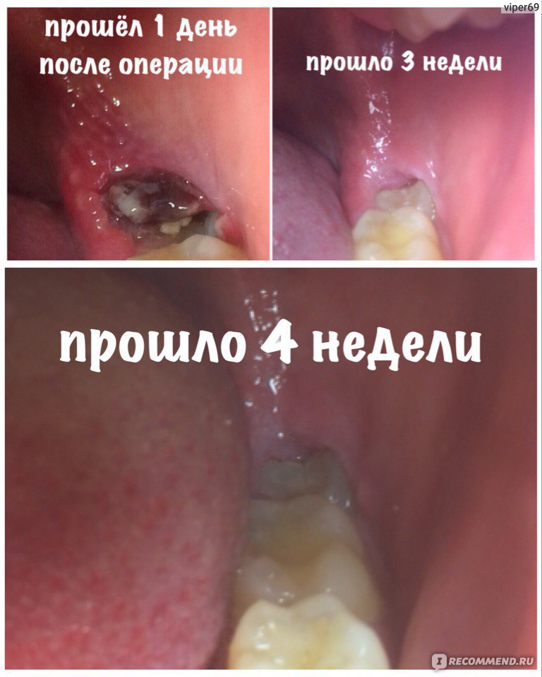 что лучше удалить зуб мудрости или капюшон?