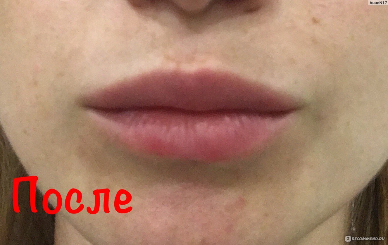 Складки на губах после гиалуроновой кислоты