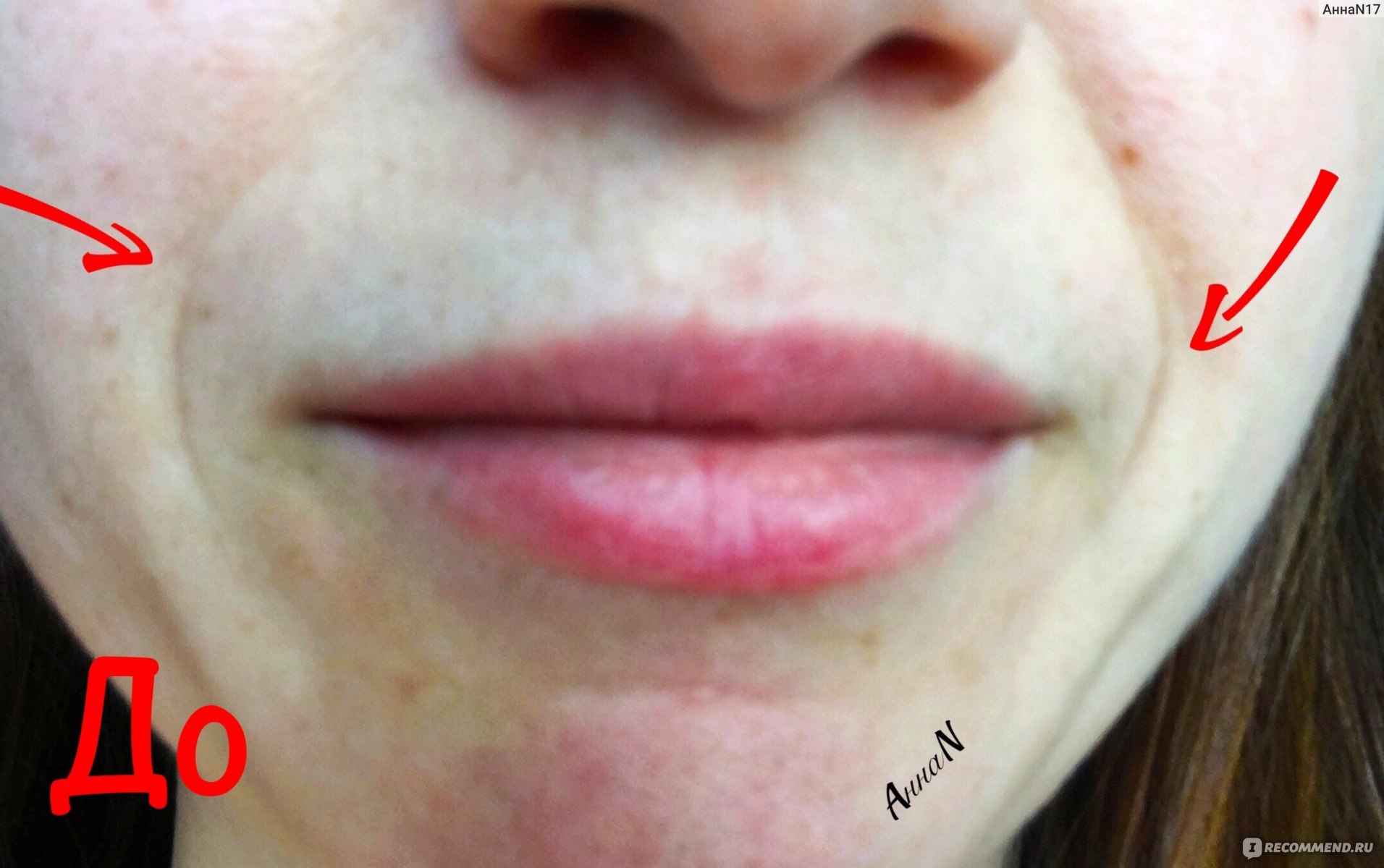 Складки на губах после гиалуроновой кислоты