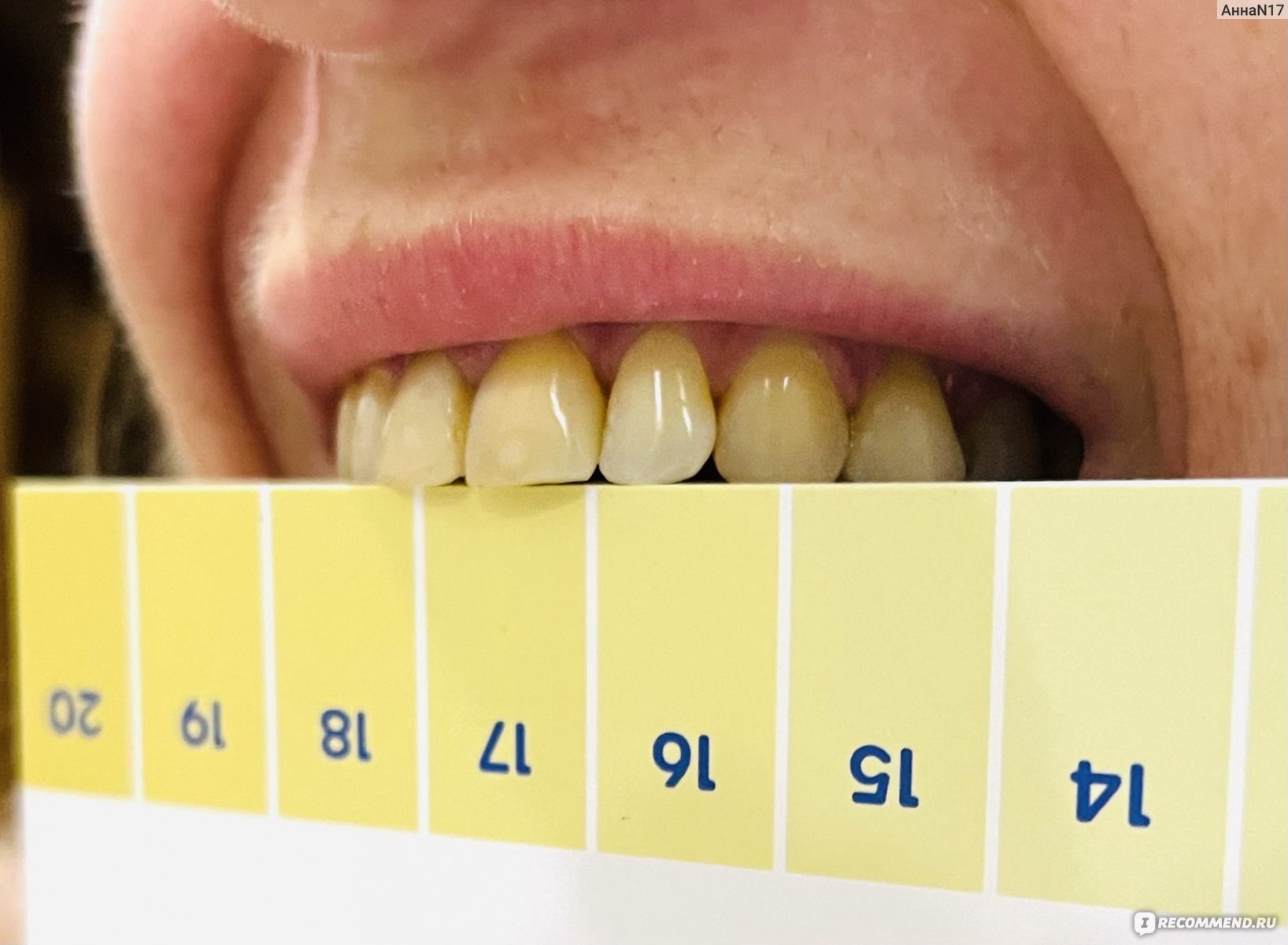 Шкала цвета зубов для отбеливания