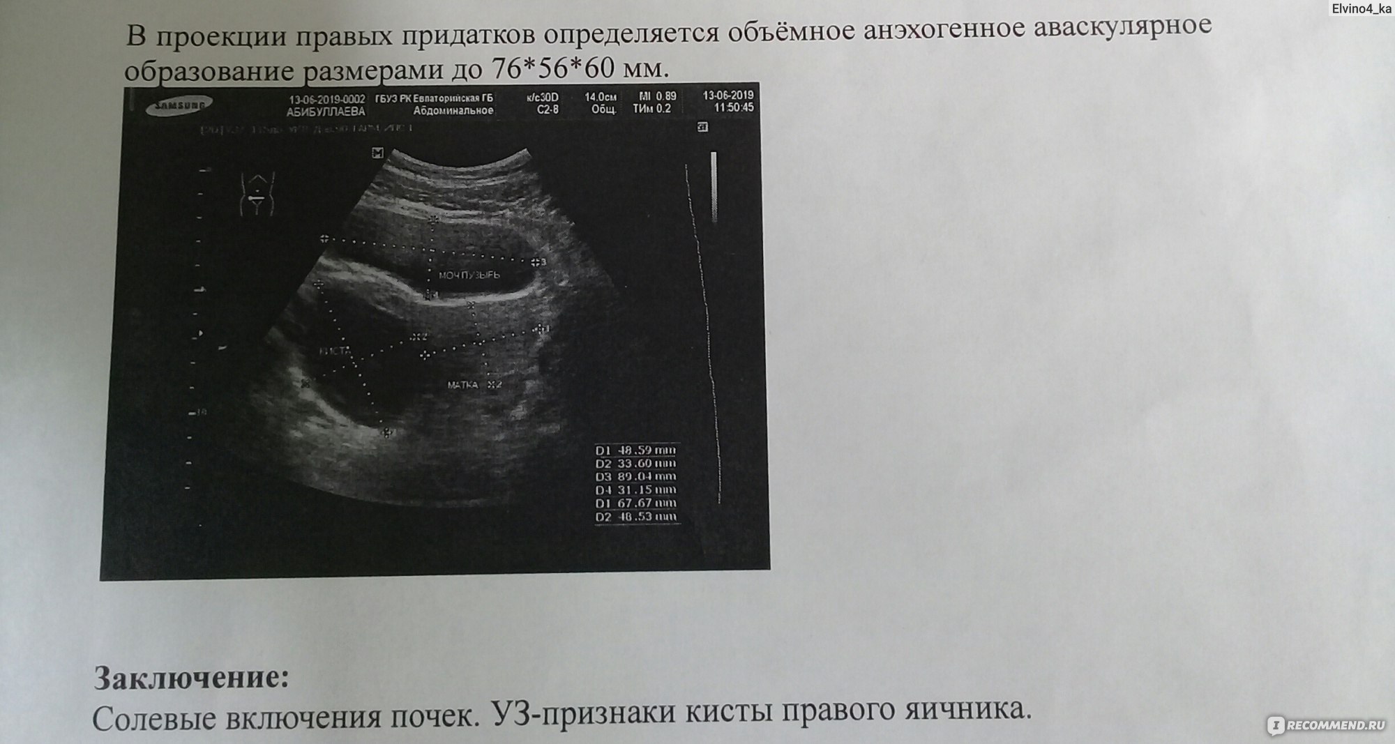 Контрацептивы Schering AG Диане-35 - «Как я избежала операции, вылечив  кисту, стала адекватным человеком и похудела на 7 кг.» | отзывы