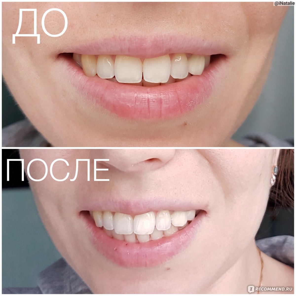 Зубы до и после отбеливающих паст