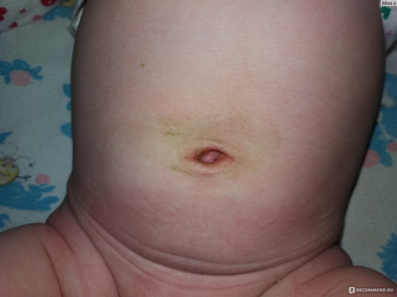 Кровит пупок у новорожденного: что делать, почему кровоточит на неделе?