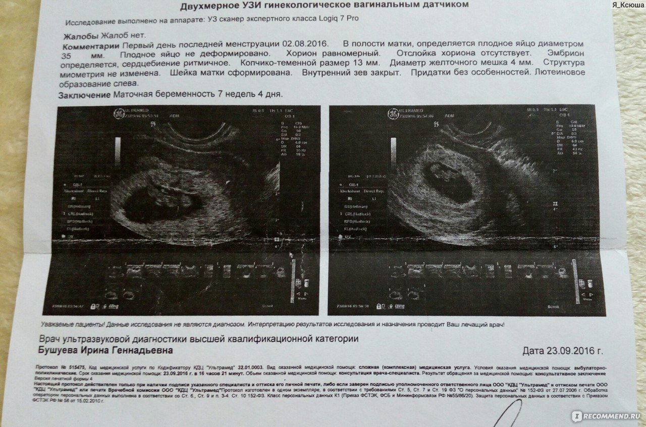 Акушерский срок 6 недель. 6 Акушерских недель беременности на УЗИ.