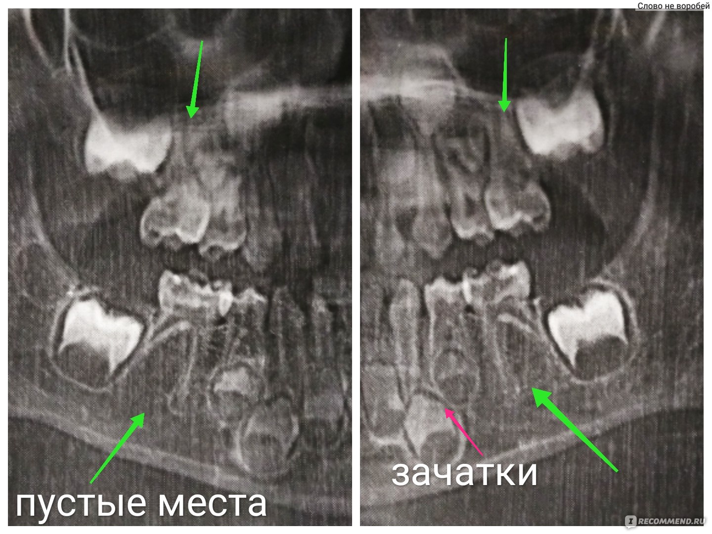 Фото зачатки зубов