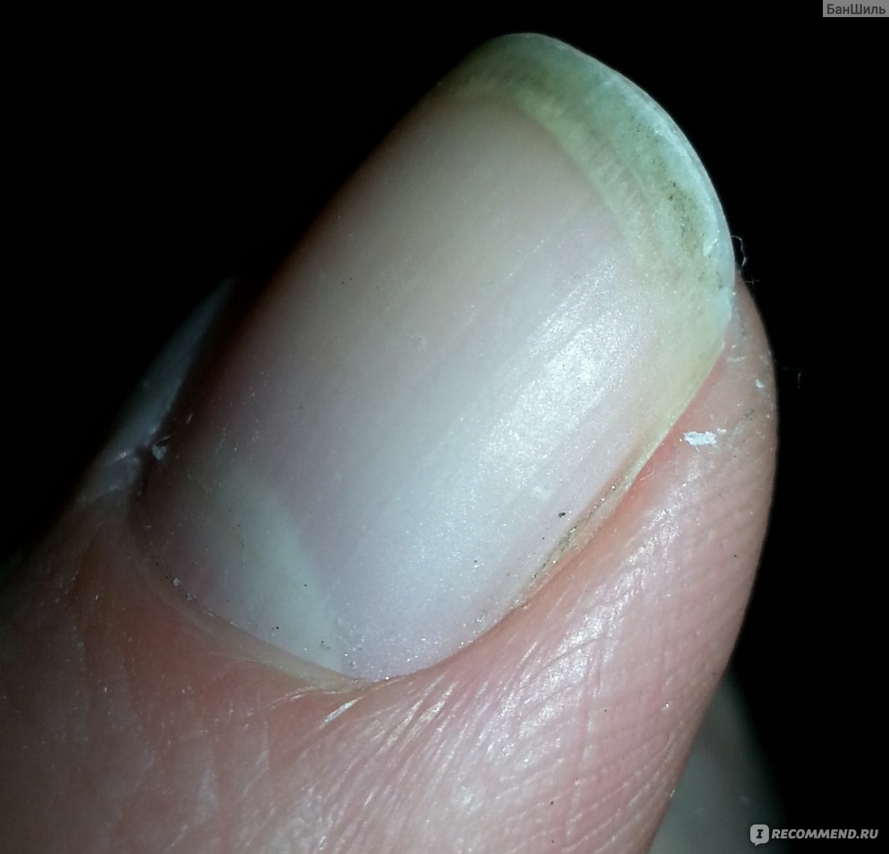 Почему слоятся и ломаются ногти — причины и способы лечения