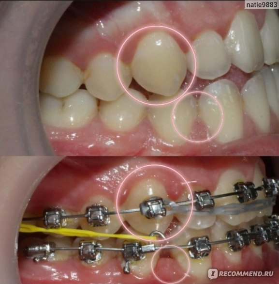 Микроимплантация зубов в ортодонтии фото
